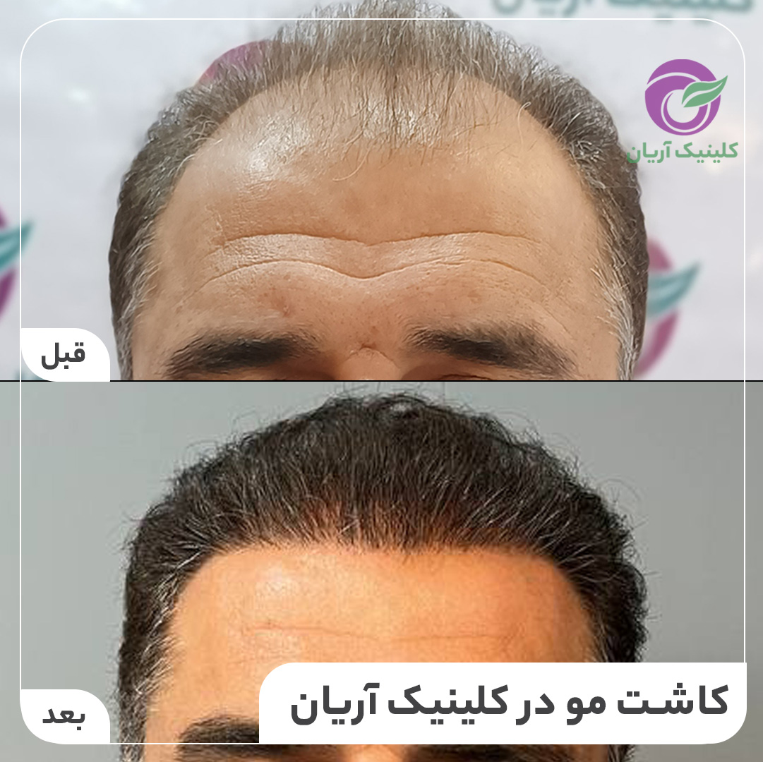 گالری کاشت مو 